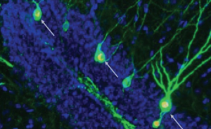 کشف راهی بالقوه برای ترمیم سیناپس های آسیب دیده در بیماری آلزایمر