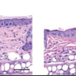 رویکرد جدید برای بیماری های التهابی پوست مانند اگزما با مزایای بزرگ